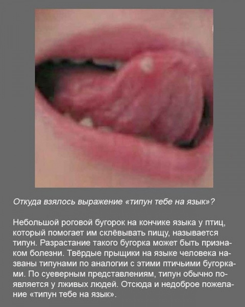 Чем вылечить типун на языке в домашних условиях Чем вылечить типун на языке в домашних условиях