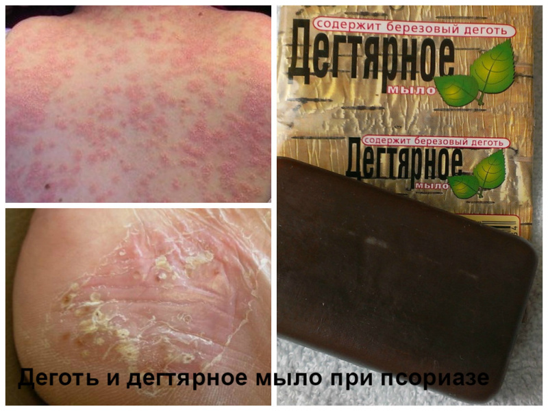 Чем лечить псориаз в домашних условиях фото Чем лечить псориаз в домашних условиях фото