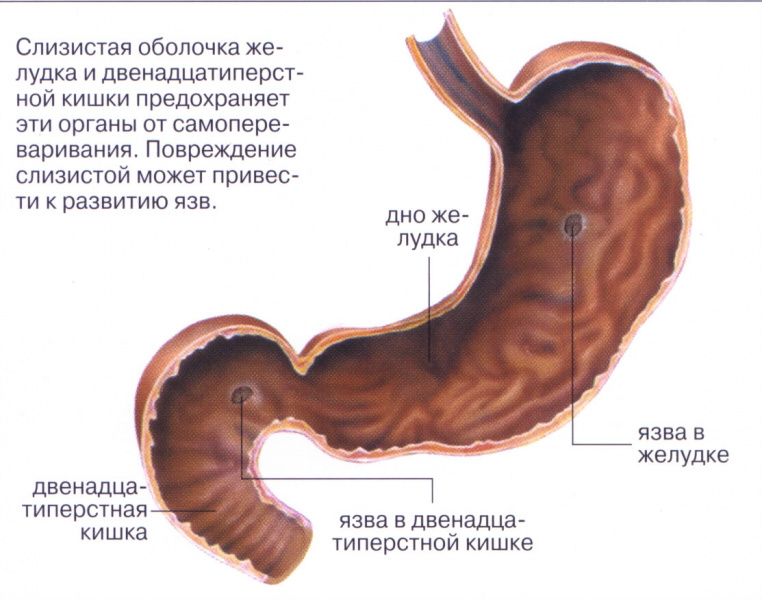 Как долго лечить язву двенадцатиперстной кишки Как долго лечить язву двенадцатиперстной кишки